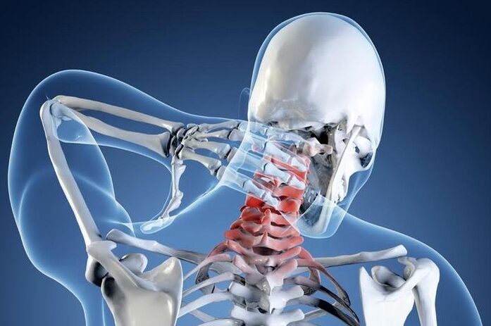 Osteochondrose des 1. Grades