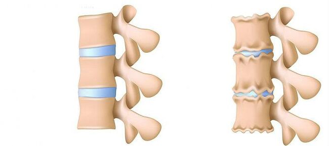 Osteochondrose der Lumbalregion